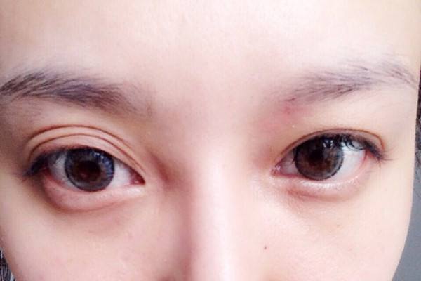 双眼皮手术后成了三眼皮还可以修复吗
