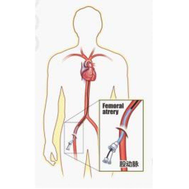 图2股动脉入路图1桡动脉入路手术过程,如下所示(图1图2)医生通过冠状