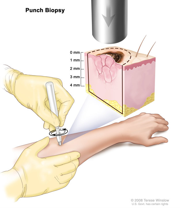 什么是皮肤活检/皮肤病理检查?应该注意什么?