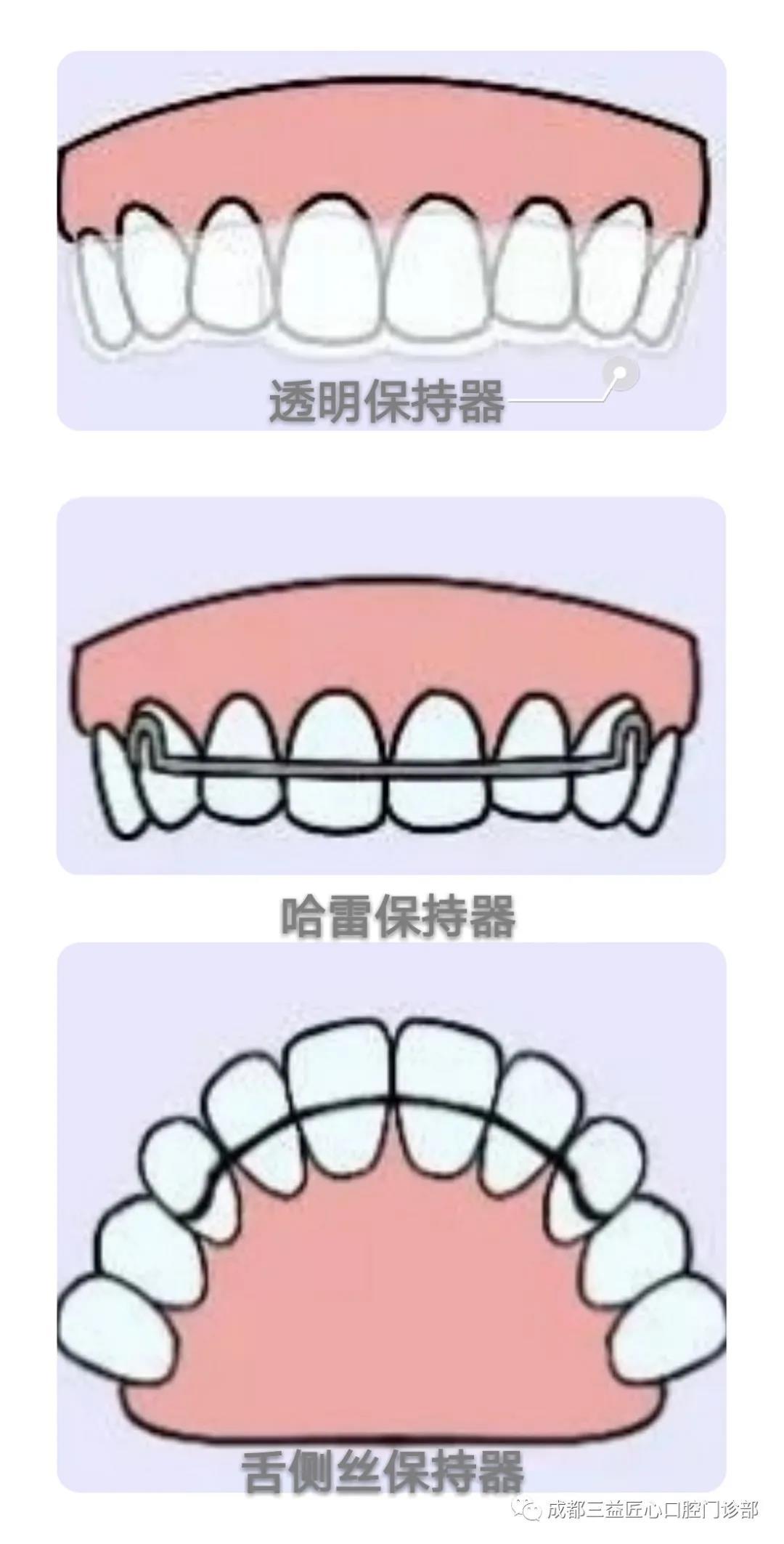 常见保持器的种类_牙颌畸形 好大夫在线