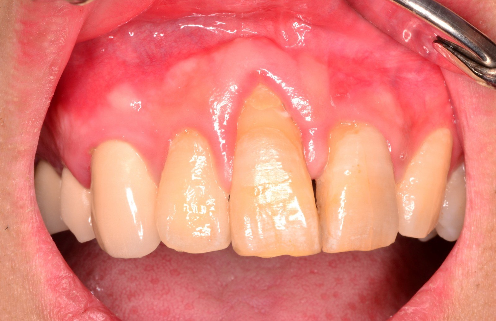 牙龈萎缩与牙槽骨破坏的关系牙周健康的原理1