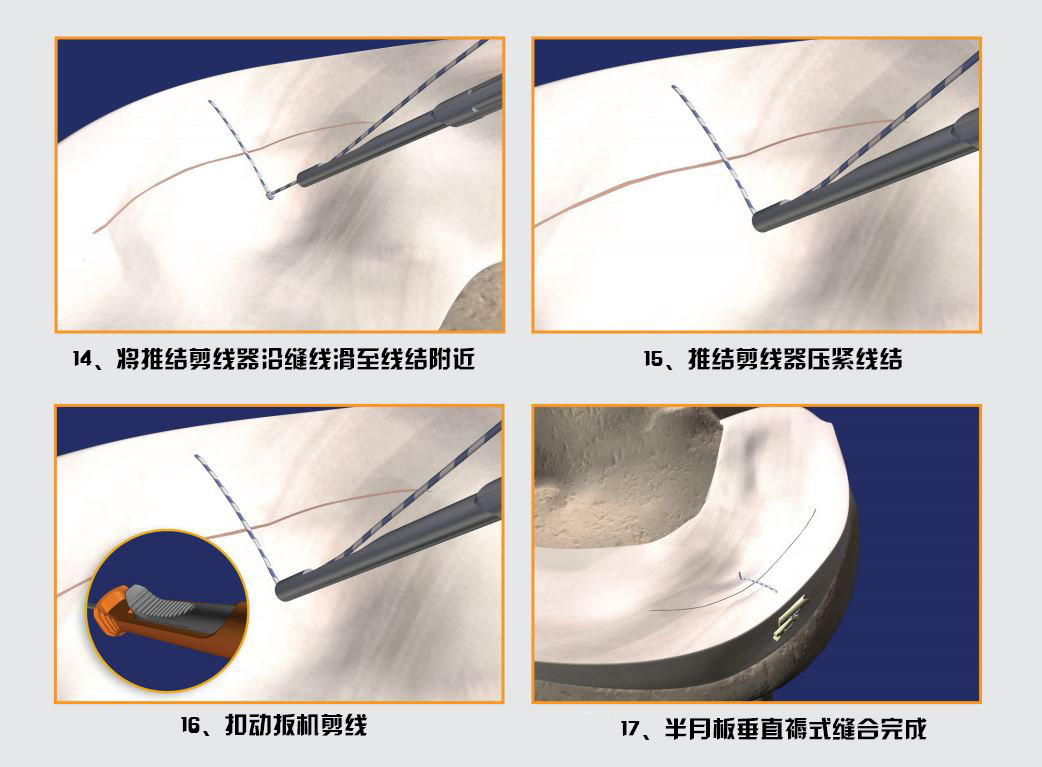 半月板缝合全内allinside技术解读