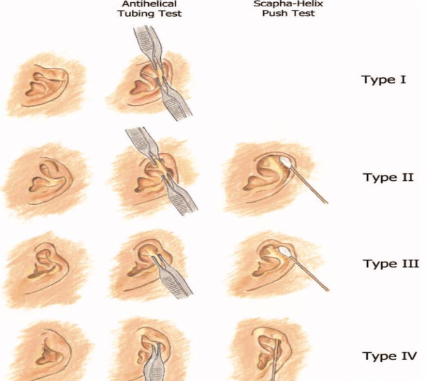 小耳畸形之杯状耳的分型及手术治疗方式
