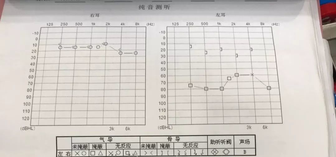 辅助检查:纯音测听左耳气导pta70db,气骨导差(abg)46db.