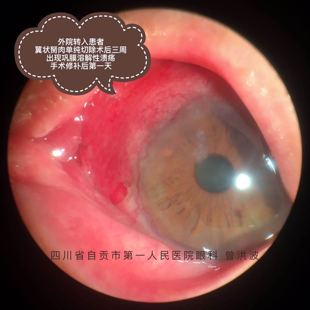 翼状胬肉手术前你想知道的都在这里(内附11张精美图片