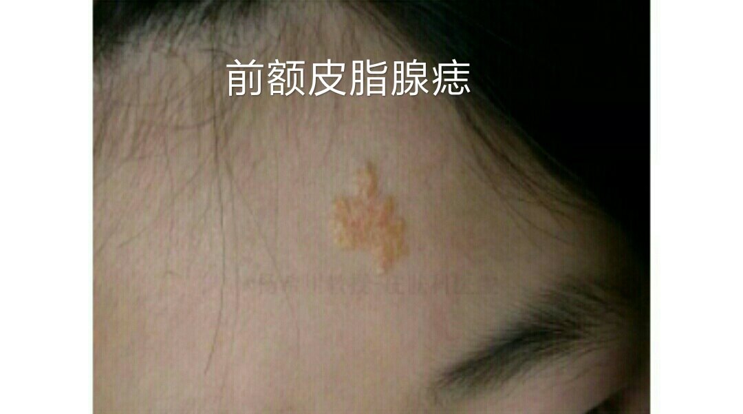 皮脂腺痣简述