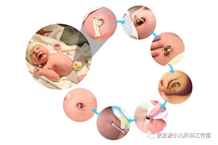 婴儿出生后,脐带被剪断结扎,正常情况下脐带残端会逐渐变干.