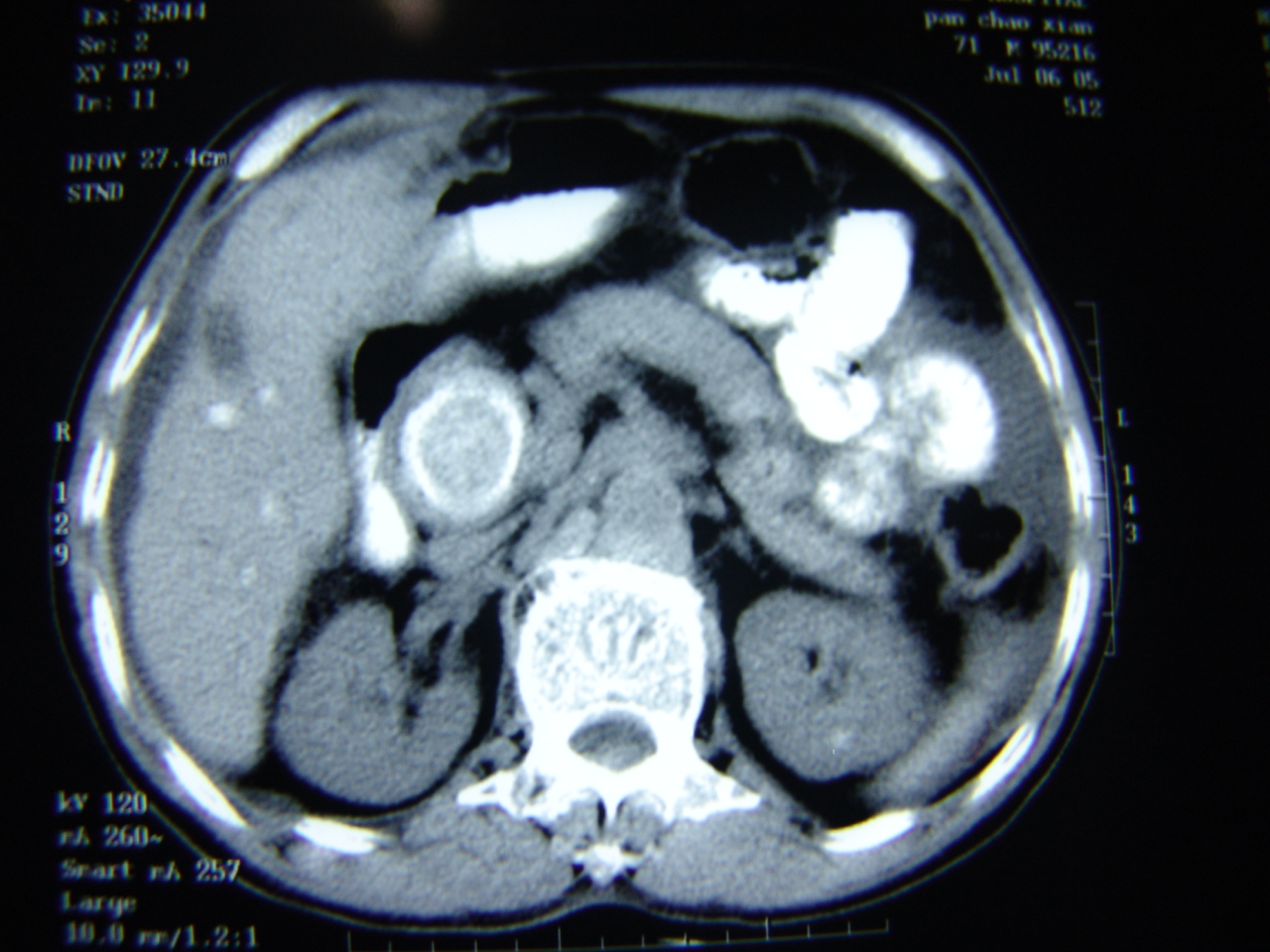 三、肝内胆管结石-肝脏、胆囊、胰脏及脾脏疾病影像诊断-医学