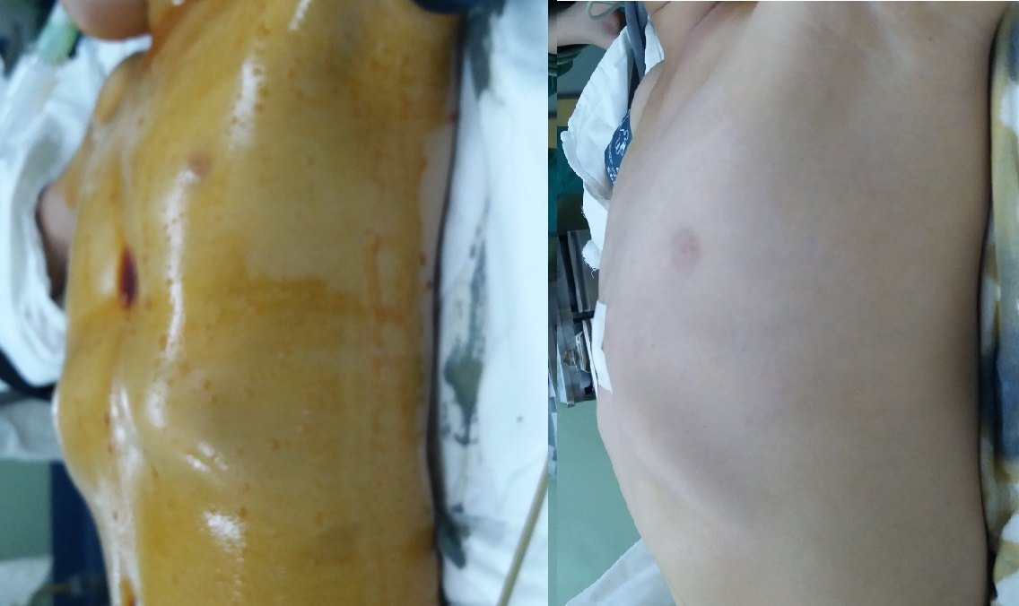 一台扁平胸合并大面积漏斗胸的改良nuss手术,患者年龄15岁(图4).