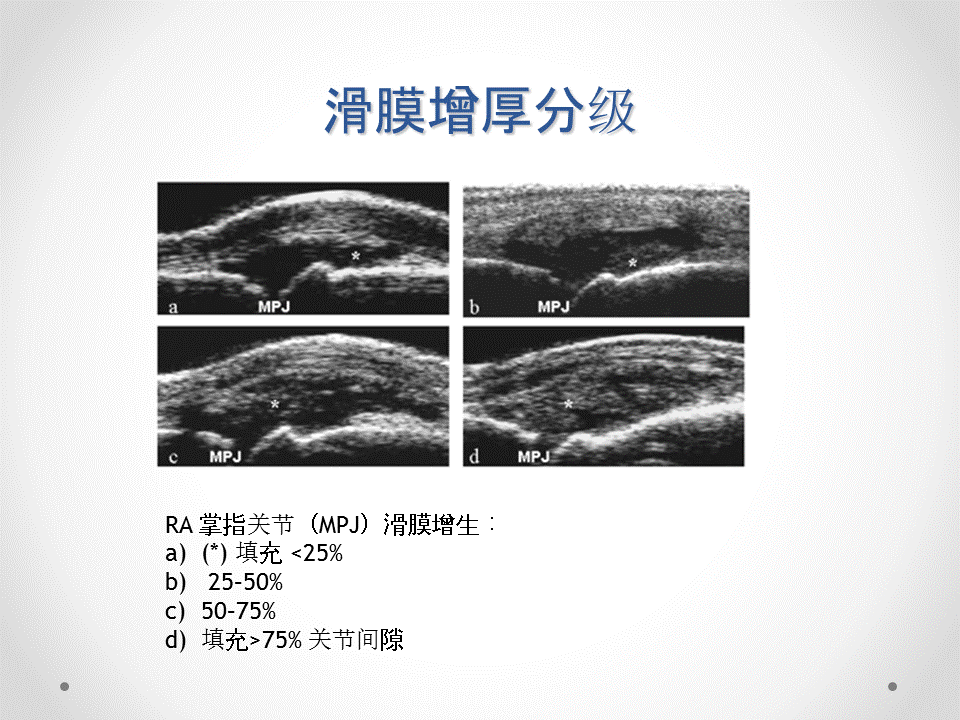 不肿不痛关节炎就好了么?肌骨关节超声帮你找出潜伏亚临床滑膜炎