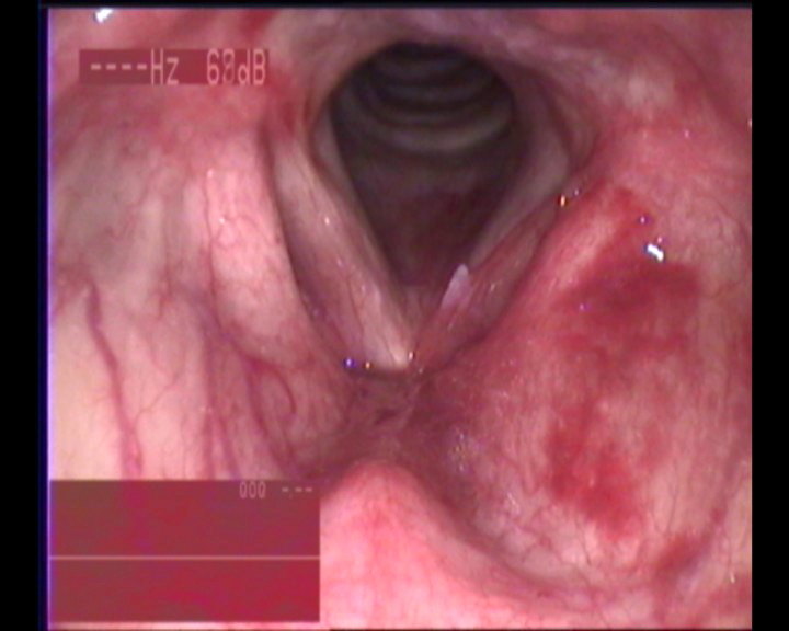 颈部外伤后失声2周,可见左侧室带声带均有黏膜淤血表现,左声带前中段