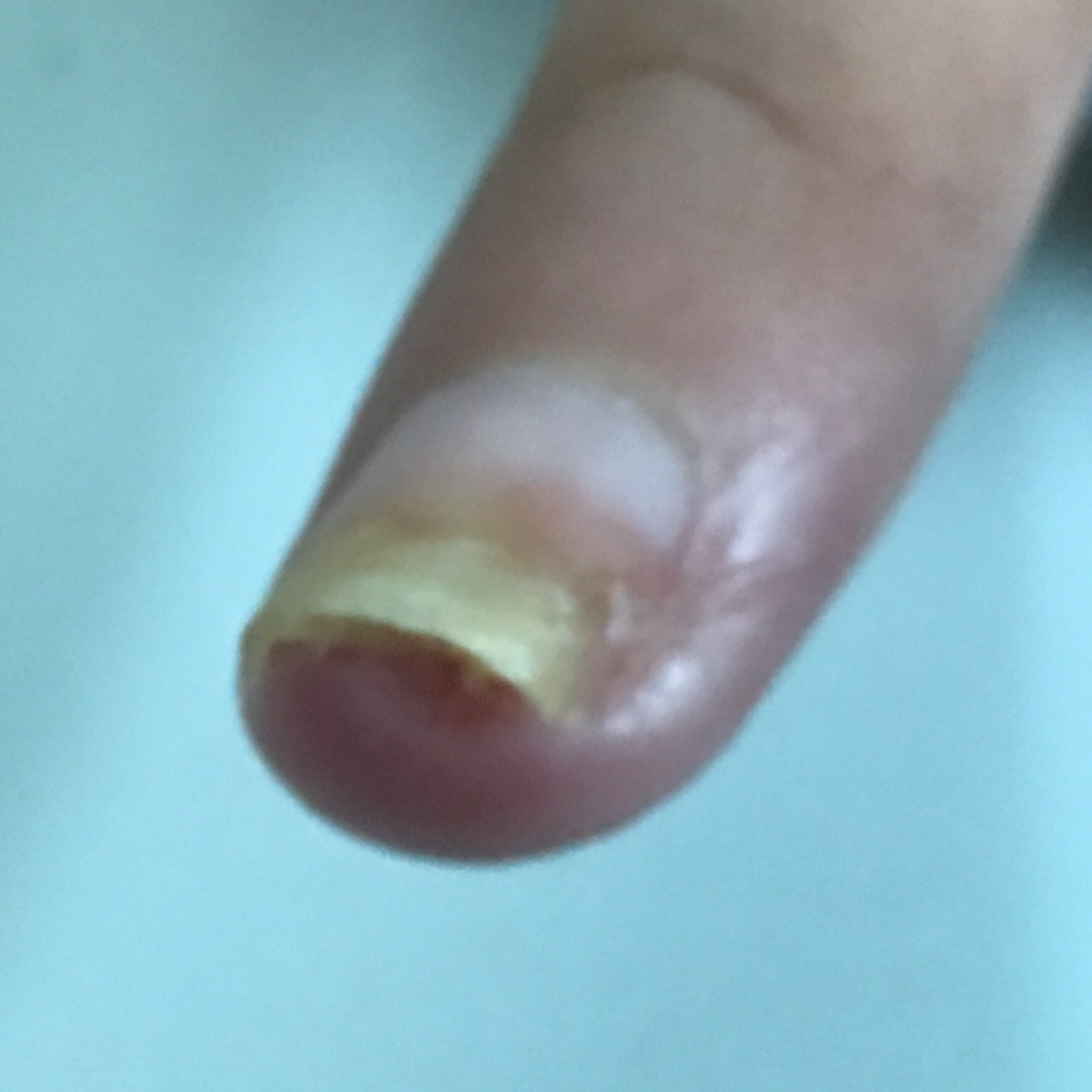 难以驱赶的真菌感染真菌性指头炎