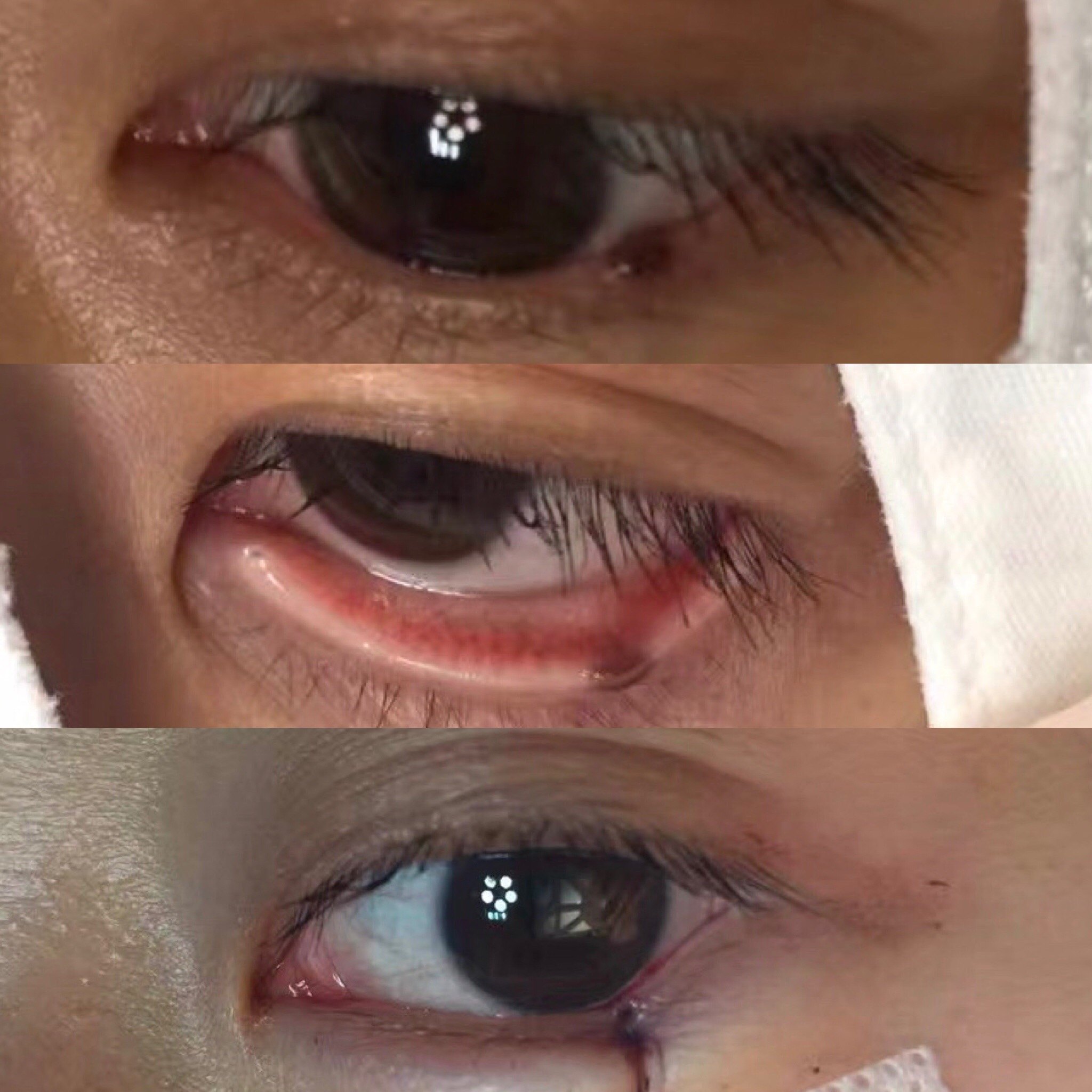 眼皮上的痣能切吗?