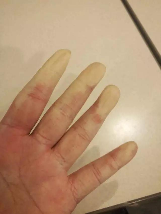 问题一:为什么我的手指会发白发紫发红?