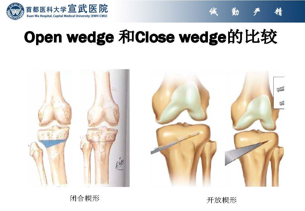 膝关节骨关节炎的保膝治疗胫骨高位截骨术