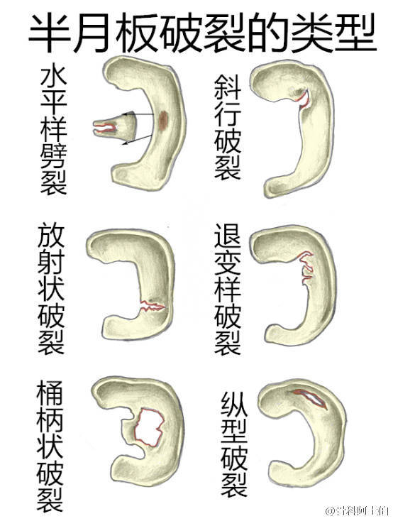 半月板伤不起