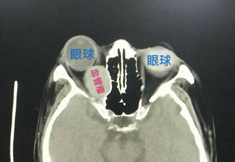 《眼睛也会生肿瘤》科普系列之海绵状血管瘤  #眼眶肿瘤##海绵状血管