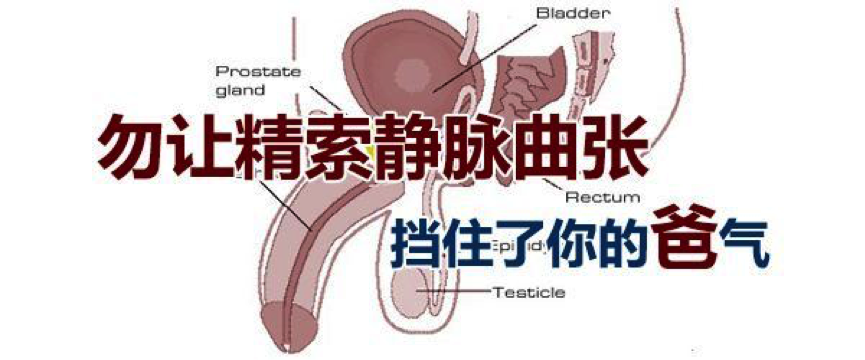 「精索静脉曲张」的你该如何选择检查和治疗方式?