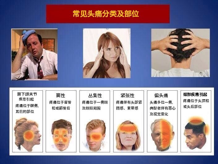 常见头痛分类及部位