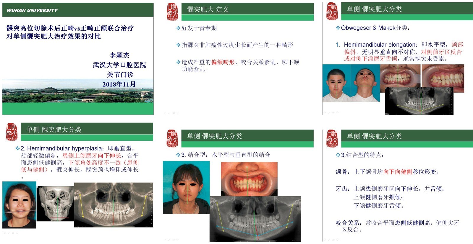 治疗单侧髁突肥大(偏颌畸形),您愿意选哪种方式?