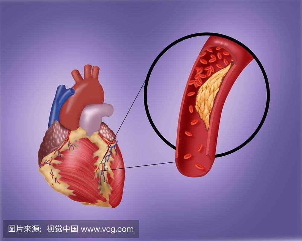 动脉硬化的原因是什么