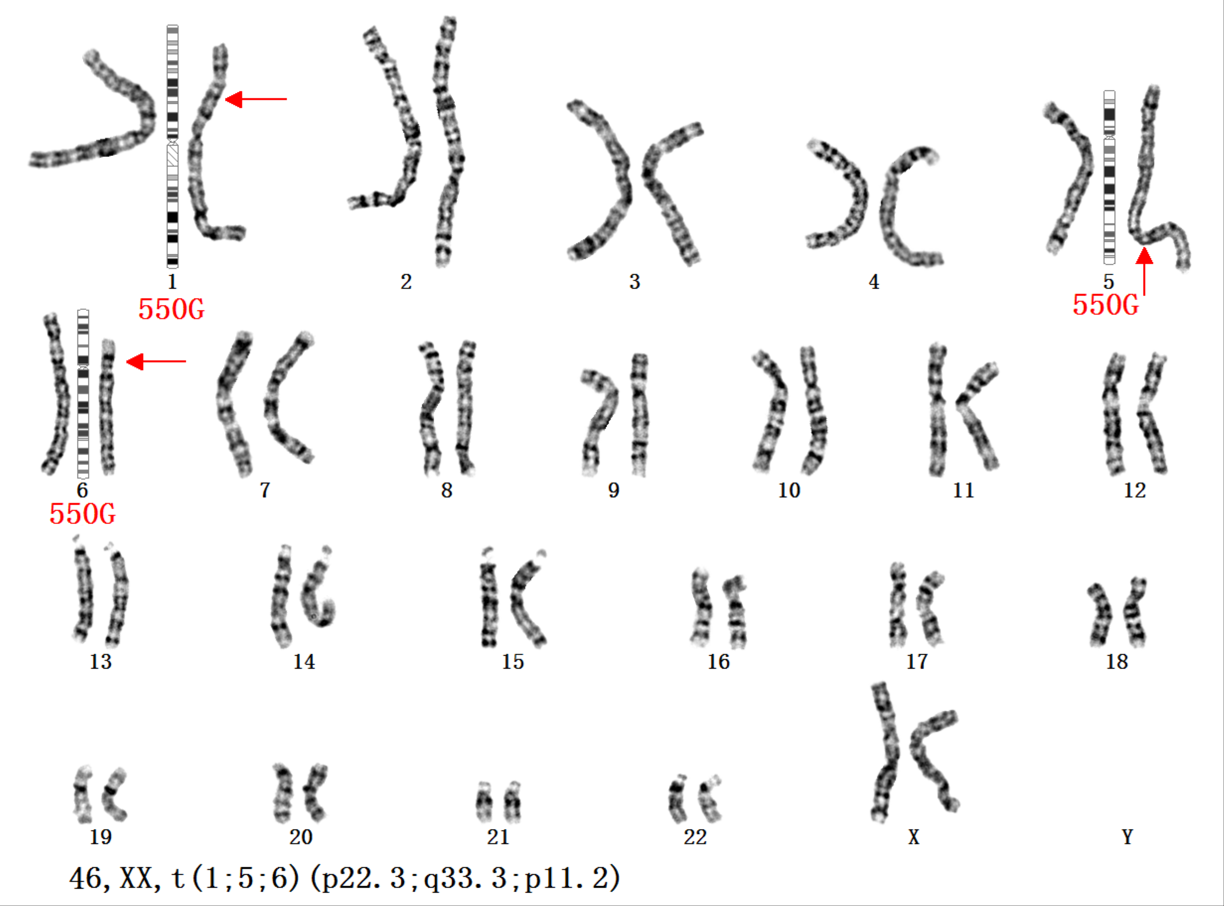 染色体结构畸变的类型