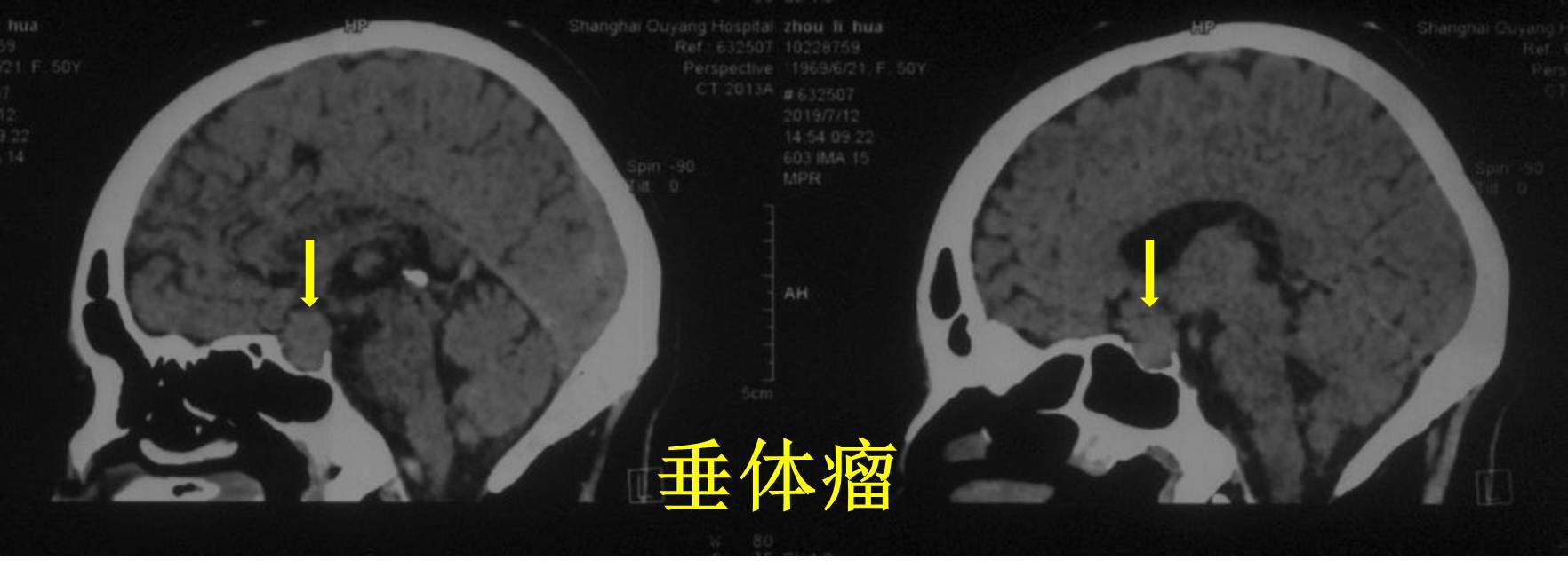 头颅ct检查提示:鞍区占位性病变,垂体瘤可能.