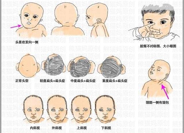 小儿斜颈的明显症状婴儿逐渐消退,胸锁乳突肌纤维性萎缩变短呈条索状