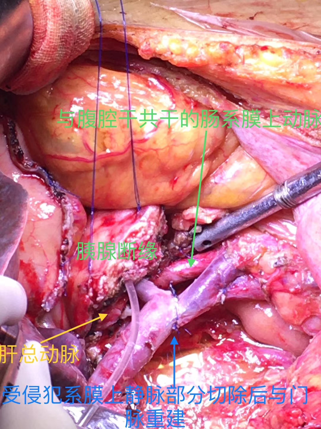 胰腺癌切除与血管重建