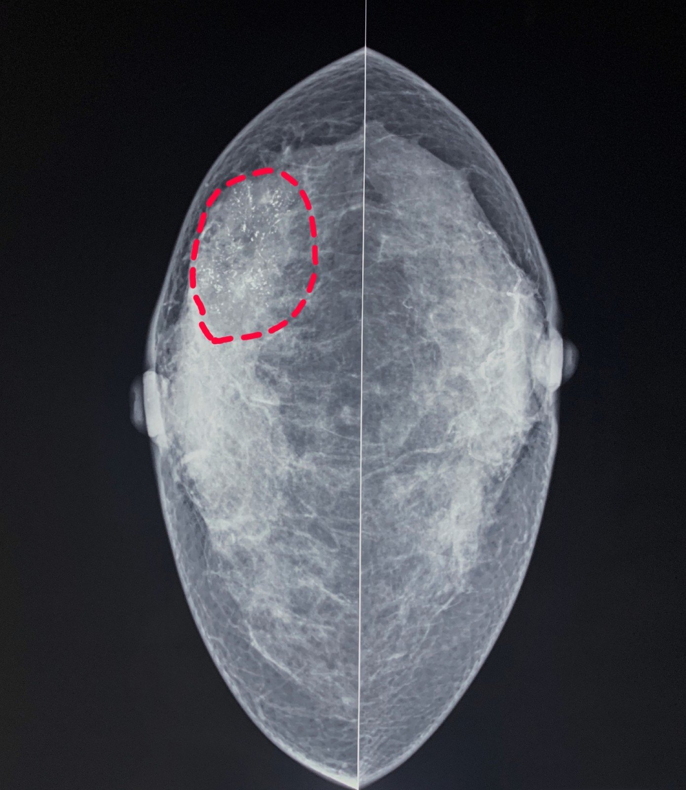 乳腺钼靶检查的辐射量有多大?