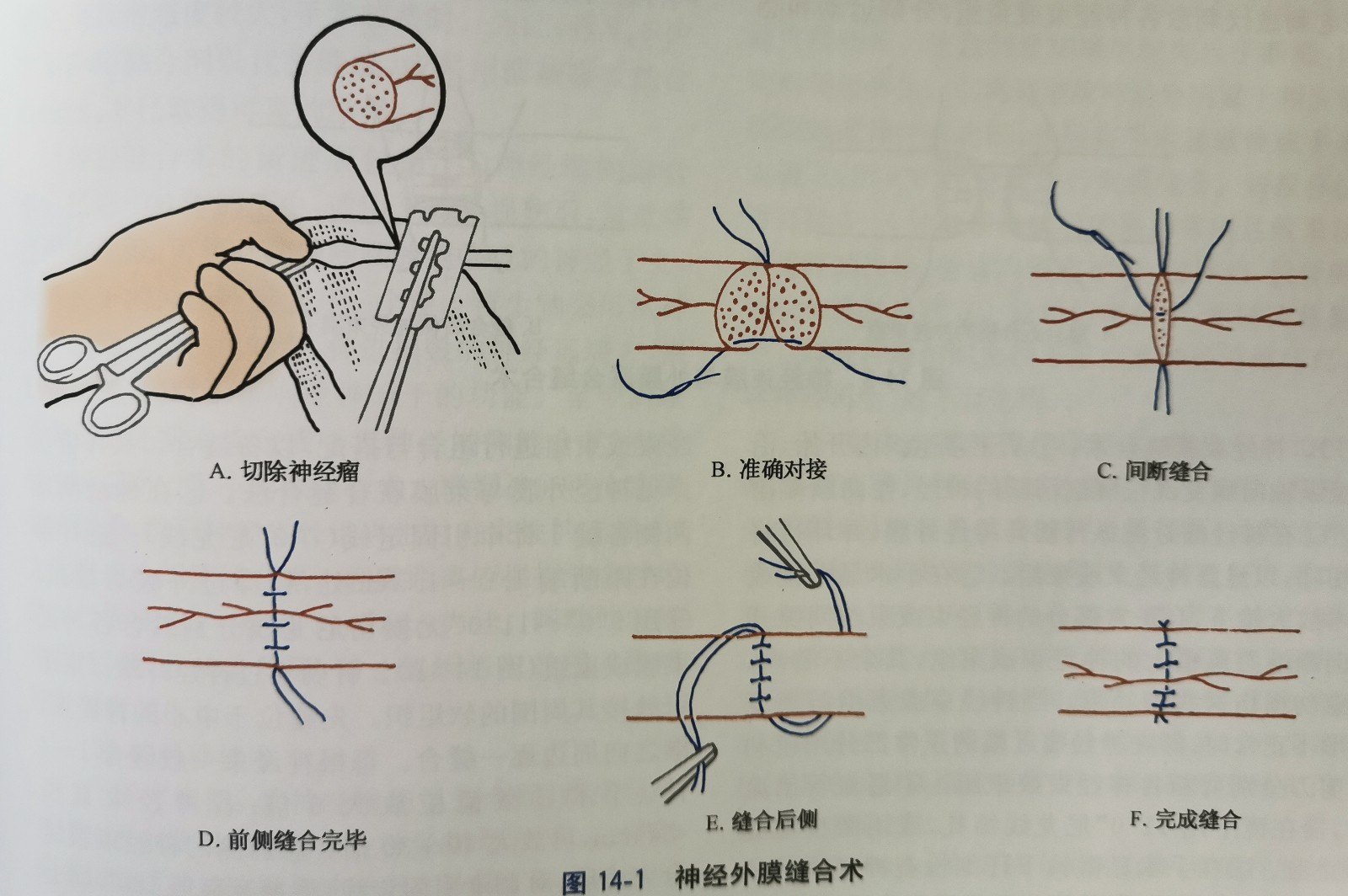 bunnell缝合法(十字交叉缝合法) 2.