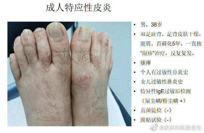 图5 成人特应性皮炎 可以只出现在手足部位,也经常被诊断为湿疹,神经