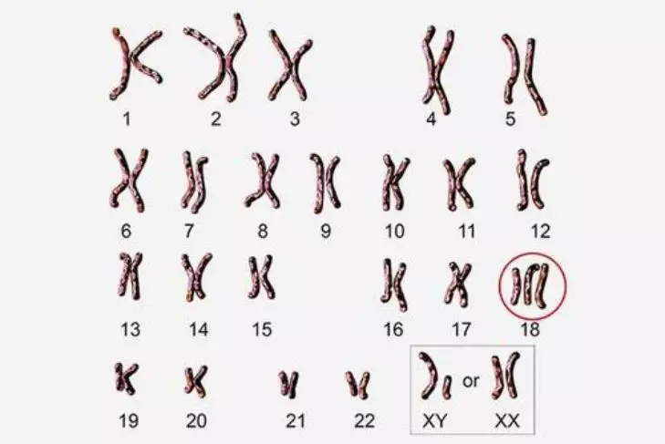 胚胎的绒毛染色体分析结果为18号染色体三体发生过一次胚胎染色体异常