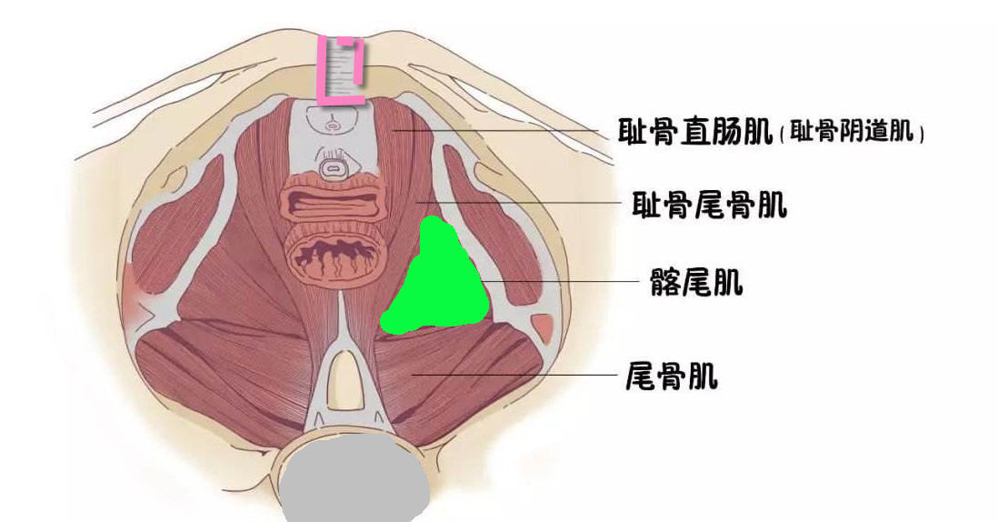 髂尾肌退化可以引起肛门痛