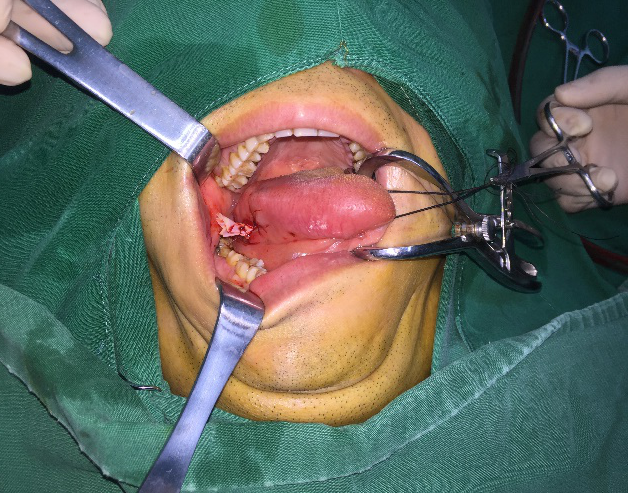 舌头肿瘤?舌头莫名长肿物疑肿瘤 检查才知竟是鱼刺插入舌头?