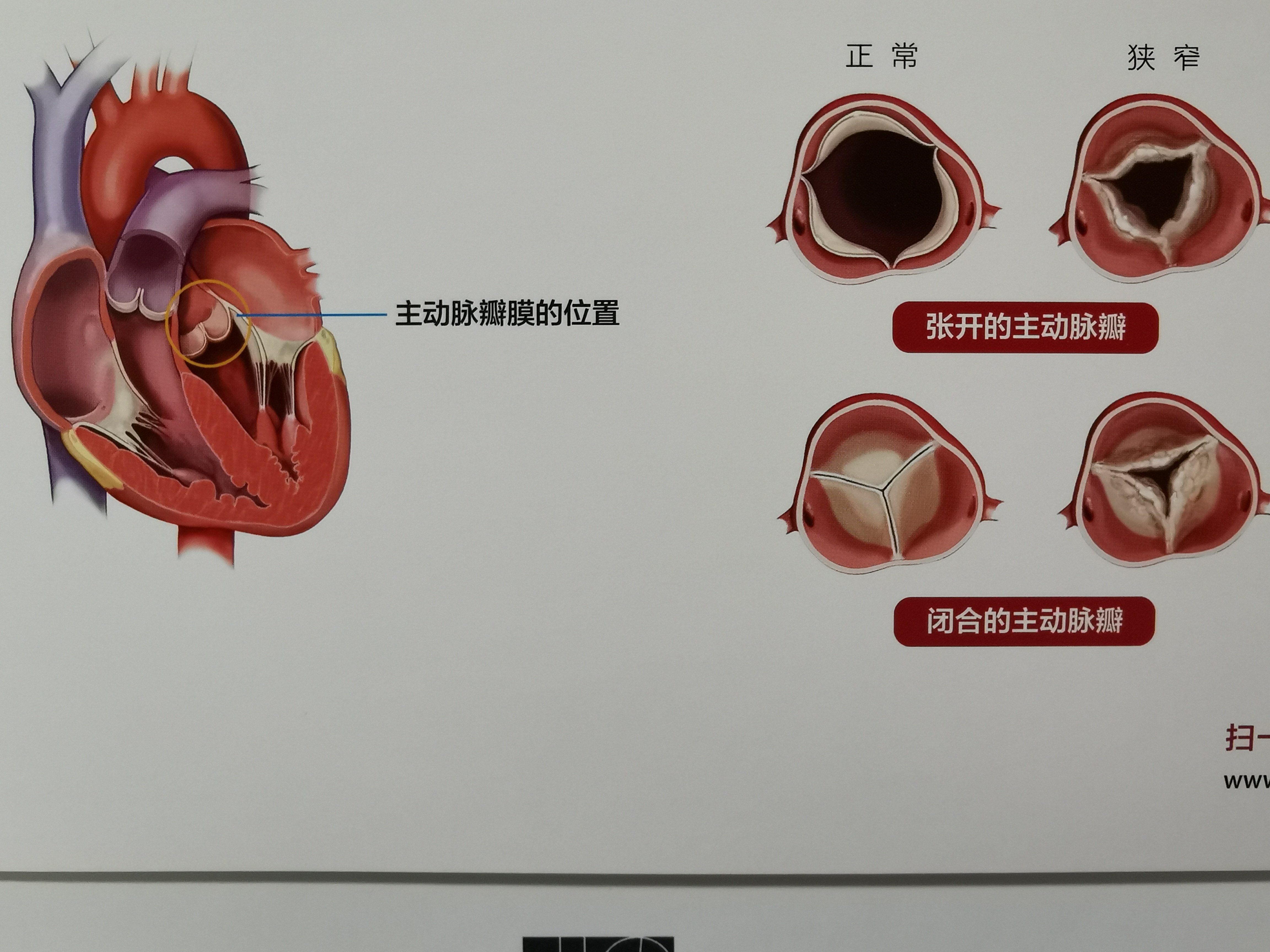 介入主动脉瓣植入治疗84岁高龄重度主动脉瓣狭窄患者