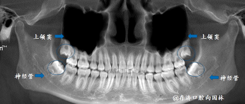 18,28,38,48埋伏阻生,18,28牙根紧贴上颌窦,38,48牙根邻近下颌神经