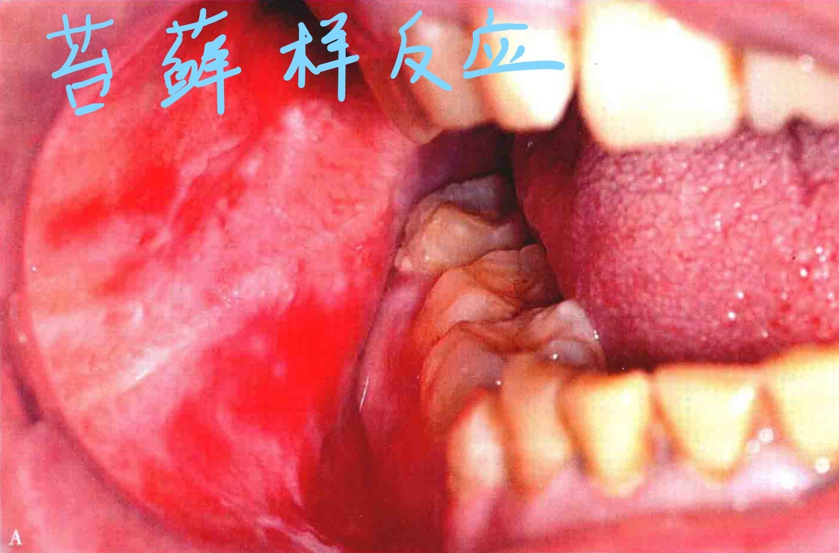 口腔黏膜—苔藓样药疹的图文介绍