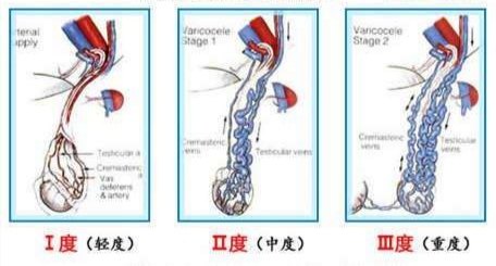 精索静脉曲张相关科普