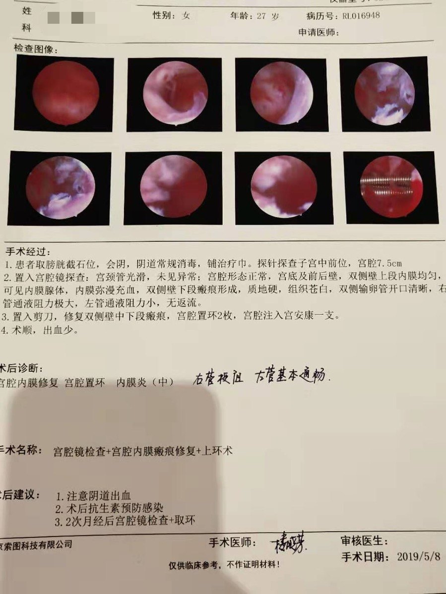 7斤小帅哥宫腔粘连很多是宫腔手术,比如人流,清宫手术造成的,子宫内膜