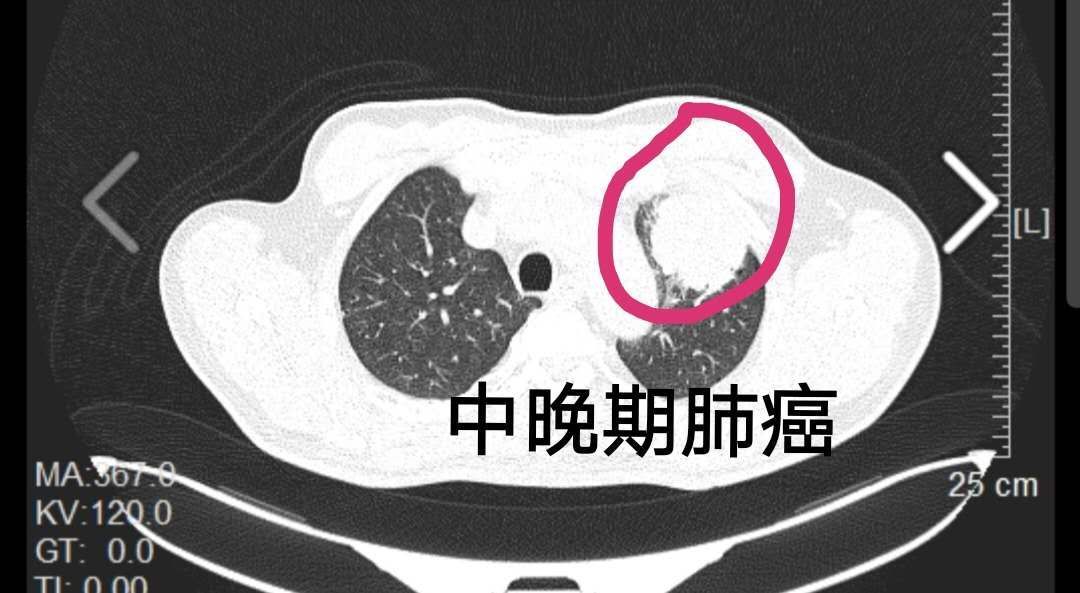 咳嗽半个月的60岁哥哥一做胸部ct发现早期肺癌什么事儿都没有的55岁