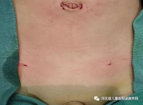 专注小儿外科疾病微创治疗之小儿鞘膜积液与疝气的区别