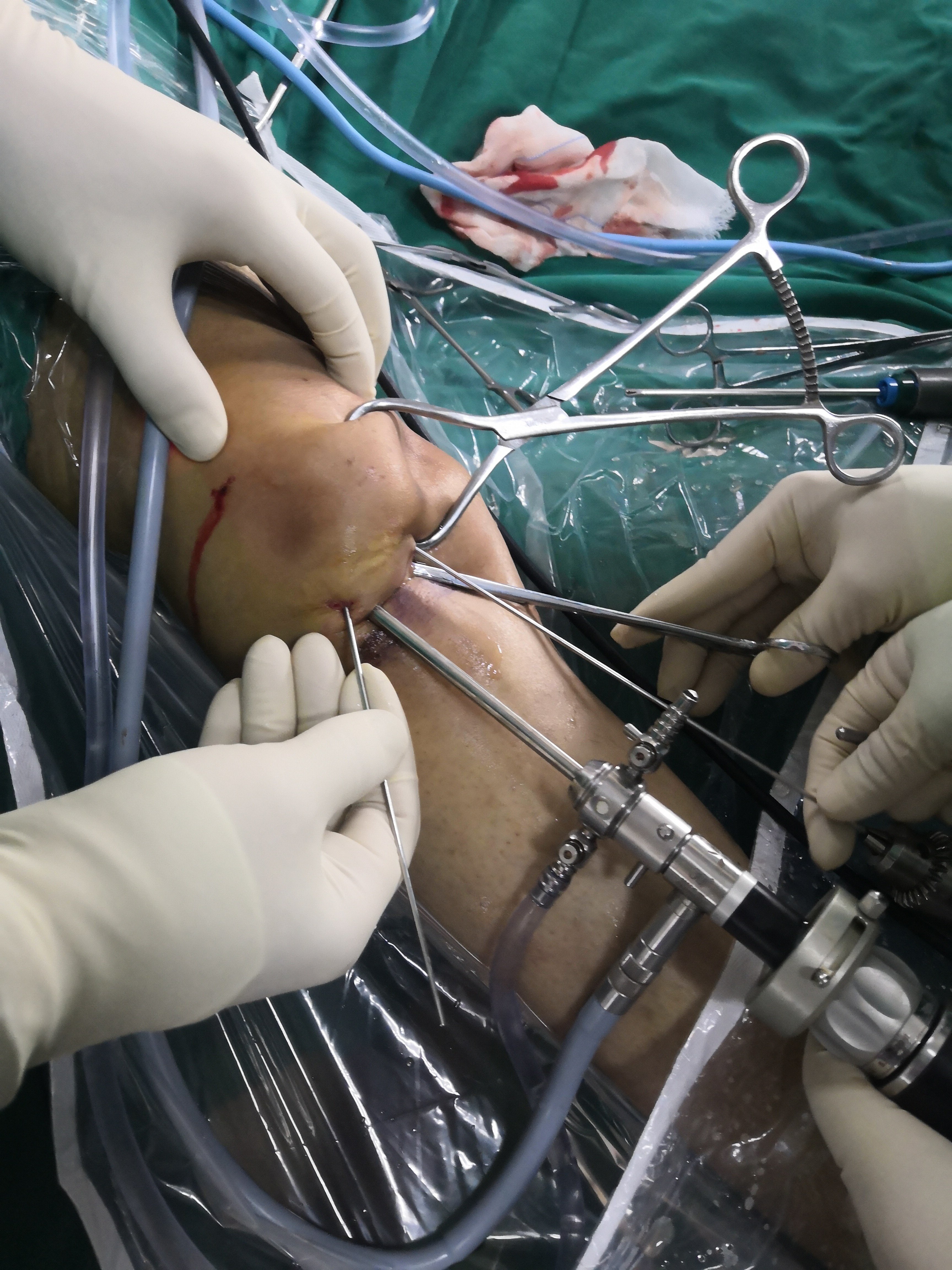 髌骨骨折——微创关节镜辅助下手术治疗