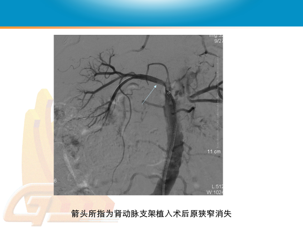 肾动脉支架有什么作用