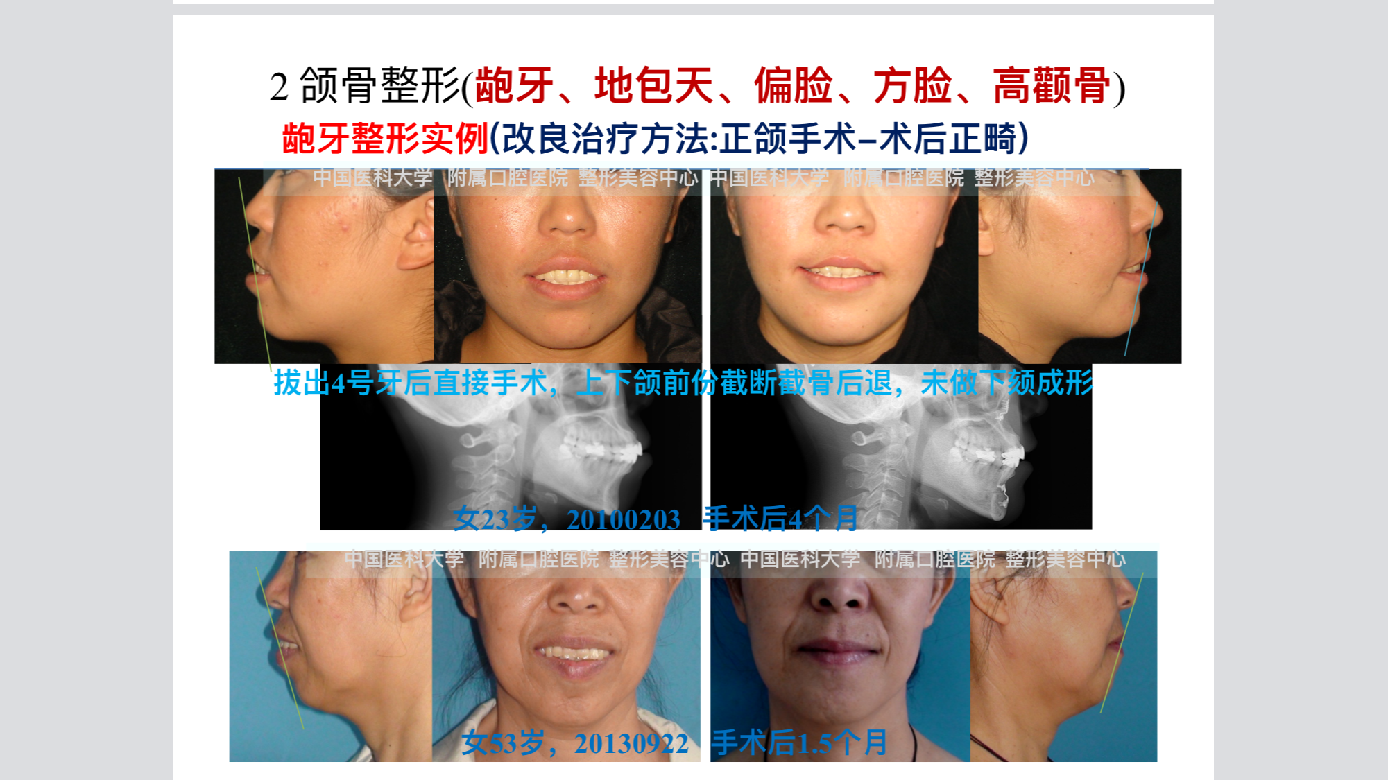 骨法手术矫正示意图1,前段截骨法:拔掉四号牙齿并切除其周围的牙槽骨