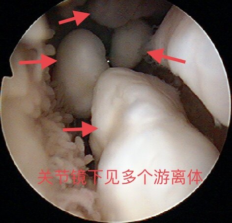 膝关节疾病之游离体