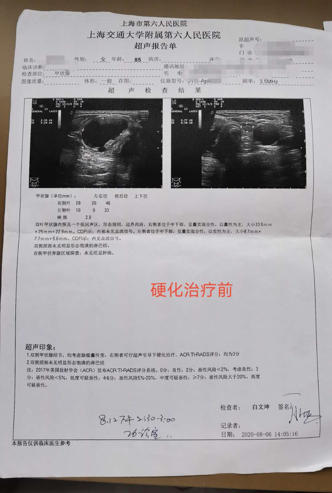 甲状腺囊肿超声引导下硬化治疗