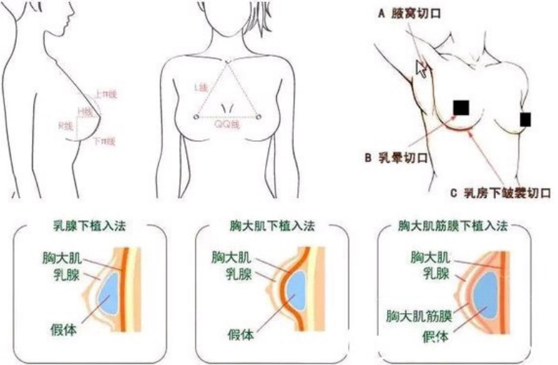 隆胸——假体隆胸手术的详细介绍