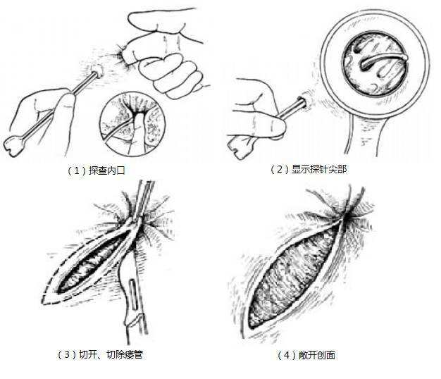 肛门炎性疾病的手术治疗