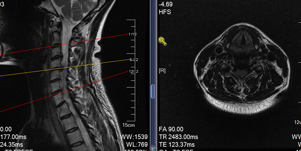 颈椎核磁共振颈椎核磁共振诊断:颈椎病(神经根型)手术方式:后路脊柱